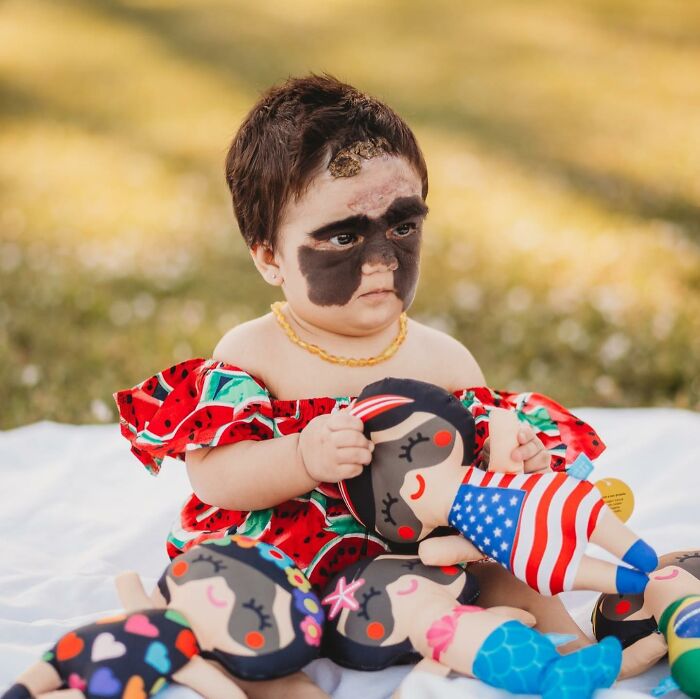 This 4-Year-Old Girl Has Undergone Multiple Surgeries To Get A Dangerous Birthmark Removed From Her Face This 4-Year-Old Girl Has Undergone Multiple Surgeries To Get A Dangerous Birthmark Removed From Her Face