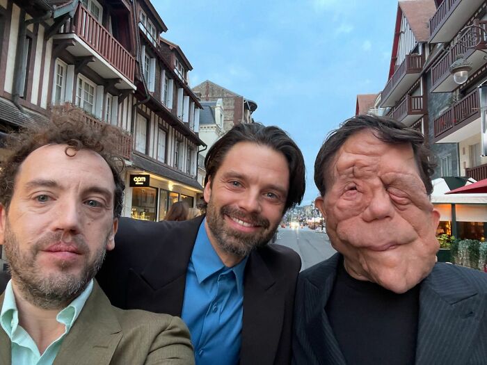 “My Disability Has Opened Doors”: Actor Adam Pearson Wants To Normalize Facial Disfigurement “My Disability Has Opened Doors”: Actor Adam Pearson Wants To Normalize Facial Disfigurement