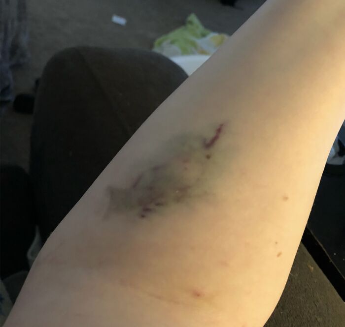 30 Times People Didn’t Think Their Symptoms Were A Big Deal, But They Were 30 Times People Didn’t Think Their Symptoms Were A Big Deal, But They Were