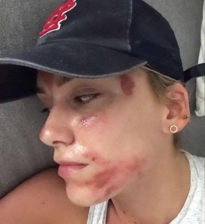 Amid Viral Injuries, Skin Expert Exposes Dangers Of Botched Microneedling Treatments (Exclusive) Amid Viral Injuries, Skin Expert Exposes Dangers Of Botched Microneedling Treatments (Exclusive)