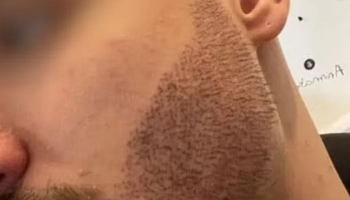 Man Takes His Own Life After Real Estate Agent Poses As Surgeon And Performs Beard Transplant Man Takes His Own Life After Real Estate Agent Poses As Surgeon And Performs Beard Transplant