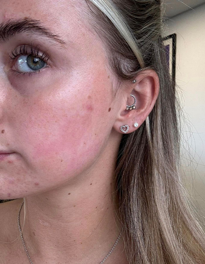 “Horrific”: Woman Suffers Second-Degree Burns After Getting Popular Beauty Procedure “Horrific”: Woman Suffers Second-Degree Burns After Getting Popular Beauty Procedure