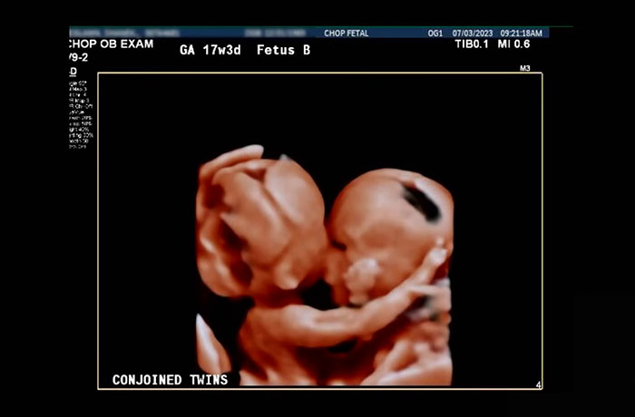 “So Grateful”: Mom Of Successfully Separated Conjoined Twins Reveals They Went Home After A Year “So Grateful”: Mom Of Successfully Separated Conjoined Twins Reveals They Went Home After A Year