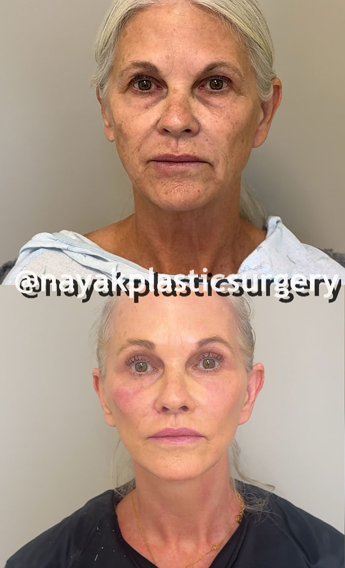 “Phenomenal Results”: 66-Year-Old Woman Undergoes 9 Surgeries In 6 Hours, Breaks The Internet “Phenomenal Results”: 66-Year-Old Woman Undergoes 9 Surgeries In 6 Hours, Breaks The Internet