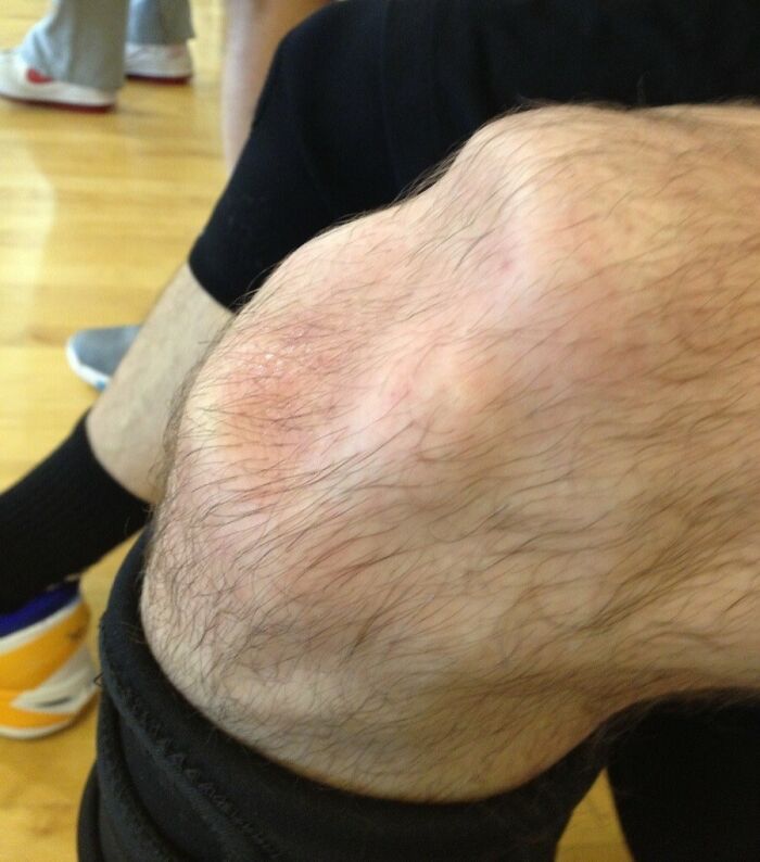 “I Have (Almost) No Eye Colour”: 40 Fascinating And Wild Things That Can Happen To The Human Body (New Pics) “I Have (Almost) No Eye Colour”: 40 Fascinating And Wild Things That Can Happen To The Human Body (New Pics)