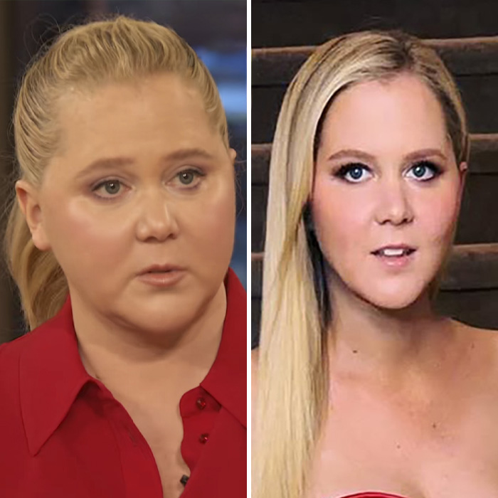 Plastic Surgeon Shares Professional Perspective On Amy Schumer’s Latest Wrinkle-Free Photos Plastic Surgeon Shares Professional Perspective On Amy Schumer’s Latest Wrinkle-Free Photos