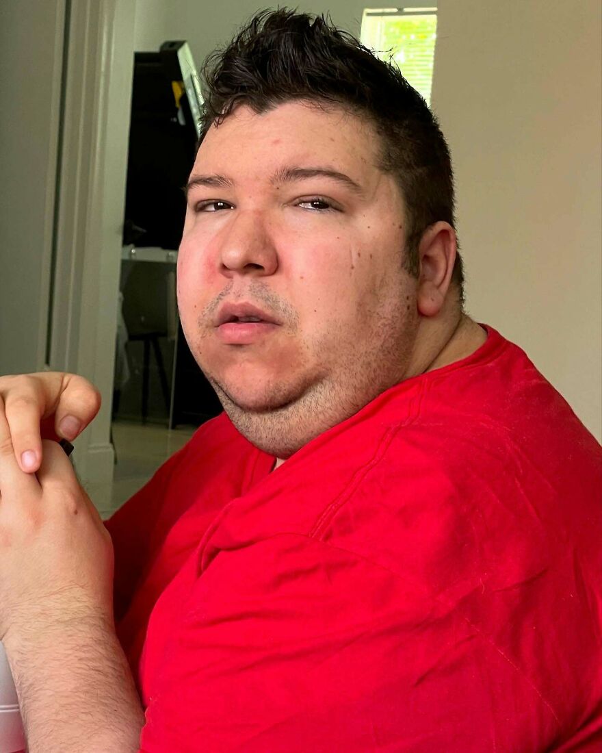 Nikocado Avocado Undergoes Cosmetic Surgery, Shares Results Nikocado Avocado Undergoes Cosmetic Surgery, Shares Results