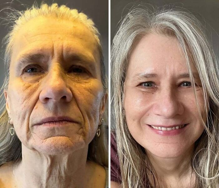 67 People Who Became Completely Unrecognizable After Getting Cosmetic Surgery In Turkey 67 People Who Became Completely Unrecognizable After Getting Cosmetic Surgery In Turkey