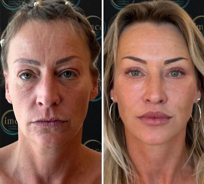 67 People Who Became Completely Unrecognizable After Getting Cosmetic Surgery In Turkey 67 People Who Became Completely Unrecognizable After Getting Cosmetic Surgery In Turkey