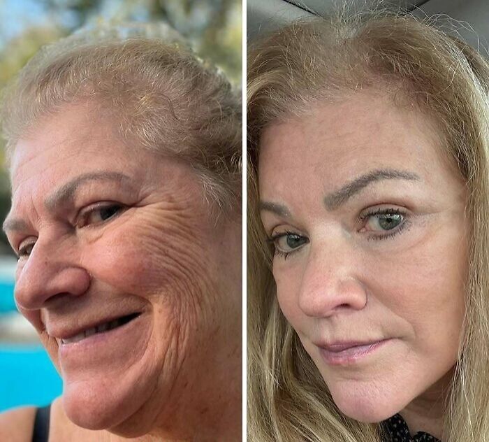 67 People Who Became Completely Unrecognizable After Getting Cosmetic Surgery In Turkey 67 People Who Became Completely Unrecognizable After Getting Cosmetic Surgery In Turkey