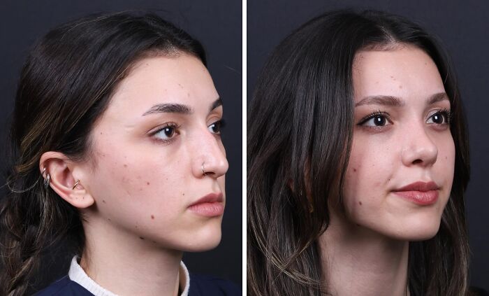 67 People Who Became Completely Unrecognizable After Getting Cosmetic Surgery In Turkey
