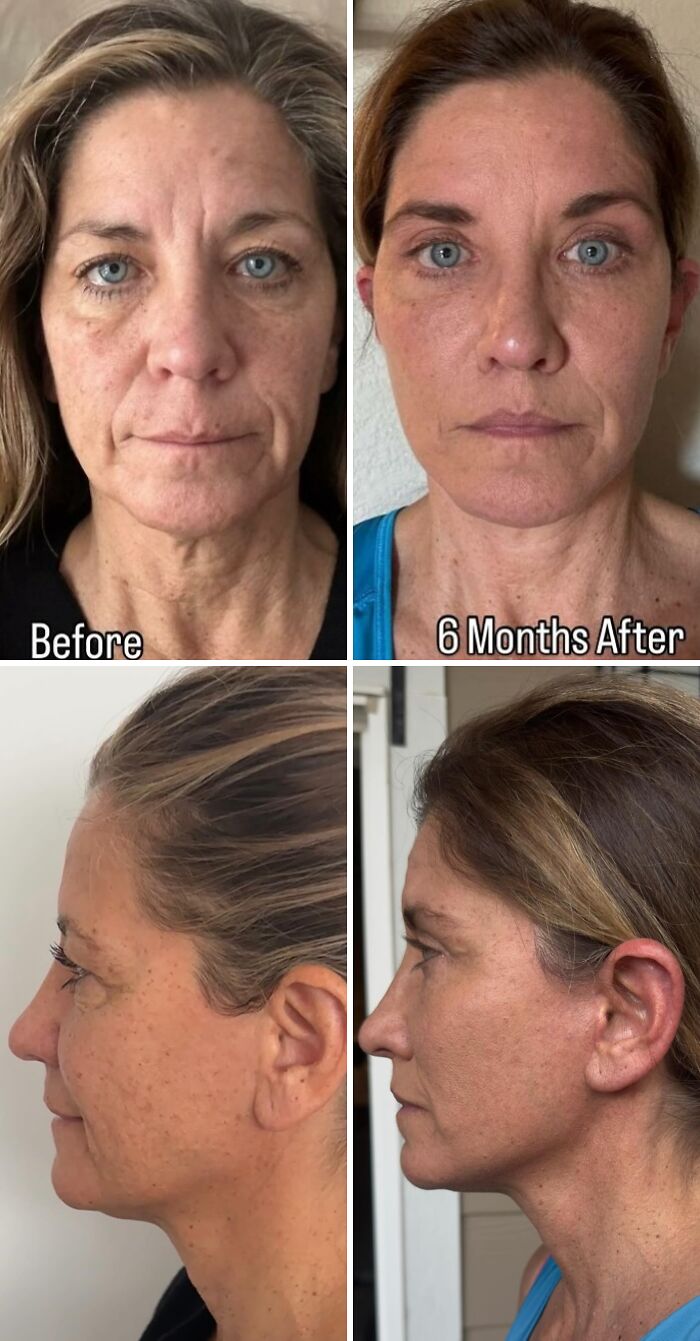 67 People Who Became Completely Unrecognizable After Getting Cosmetic Surgery In Turkey 67 People Who Became Completely Unrecognizable After Getting Cosmetic Surgery In Turkey