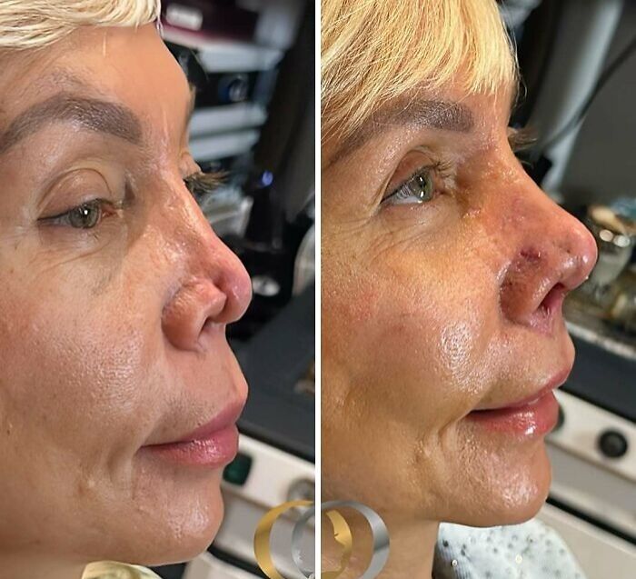 67 People Who Became Completely Unrecognizable After Getting Cosmetic Surgery In Turkey 67 People Who Became Completely Unrecognizable After Getting Cosmetic Surgery In Turkey