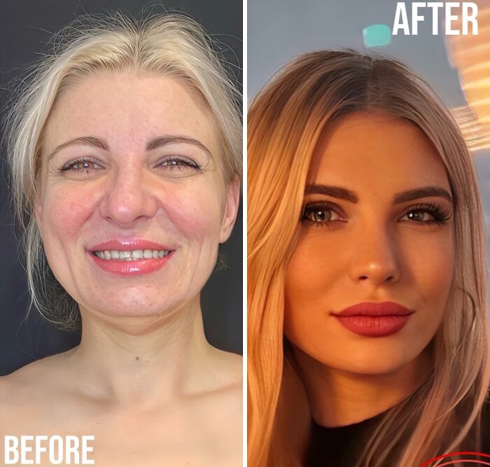 67 People Who Became Completely Unrecognizable After Getting Cosmetic Surgery In Turkey
