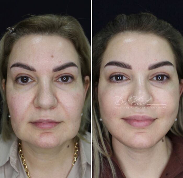 67 People Who Became Completely Unrecognizable After Getting Cosmetic Surgery In Turkey 67 People Who Became Completely Unrecognizable After Getting Cosmetic Surgery In Turkey