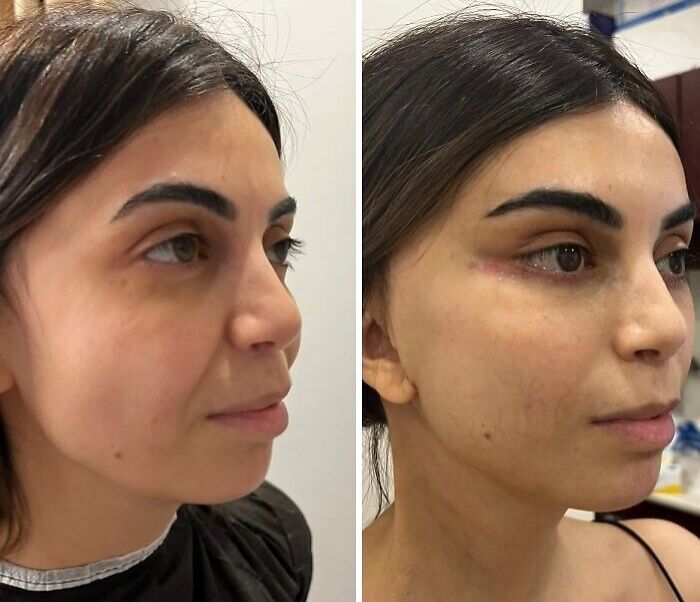 67 People Who Became Completely Unrecognizable After Getting Cosmetic Surgery In Turkey