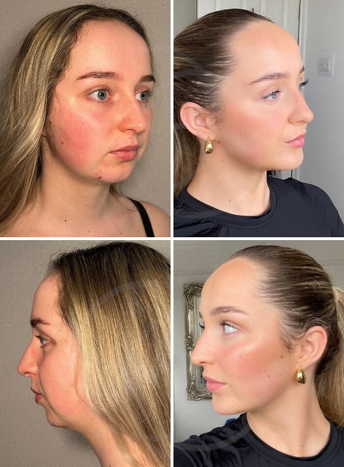 67 People Who Became Completely Unrecognizable After Getting Cosmetic Surgery In Turkey 67 People Who Became Completely Unrecognizable After Getting Cosmetic Surgery In Turkey