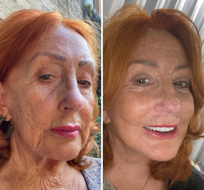 67 People Who Became Completely Unrecognizable After Getting Cosmetic Surgery In Turkey