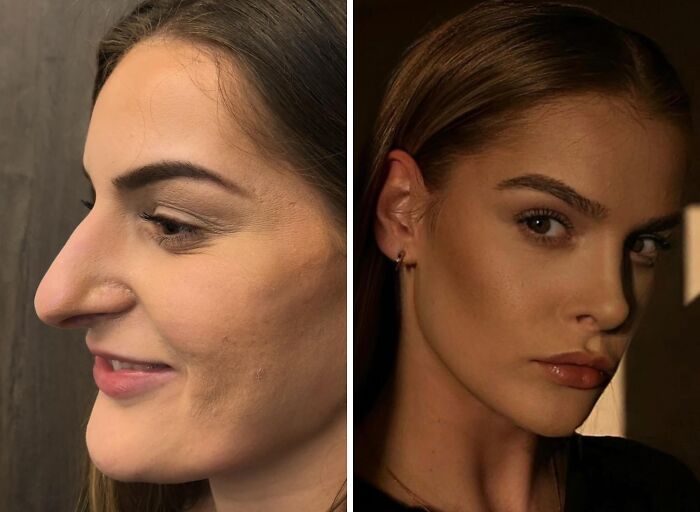 67 People Who Became Completely Unrecognizable After Getting Cosmetic Surgery In Turkey 67 People Who Became Completely Unrecognizable After Getting Cosmetic Surgery In Turkey