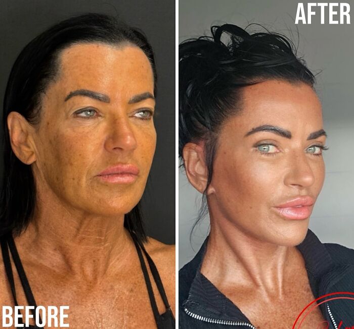 67 People Who Became Completely Unrecognizable After Getting Cosmetic Surgery In Turkey