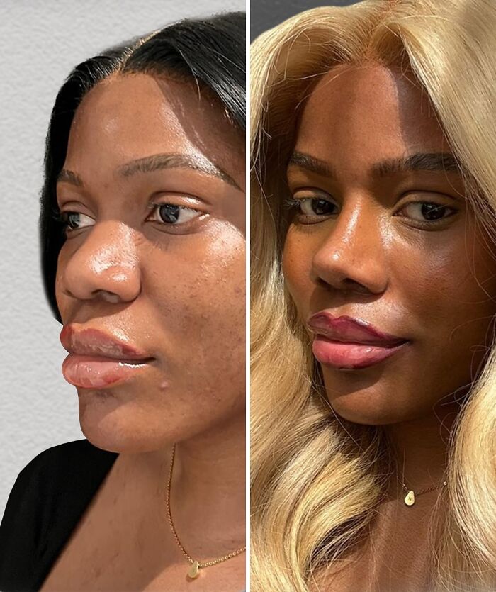 67 People Who Became Completely Unrecognizable After Getting Cosmetic Surgery In Turkey