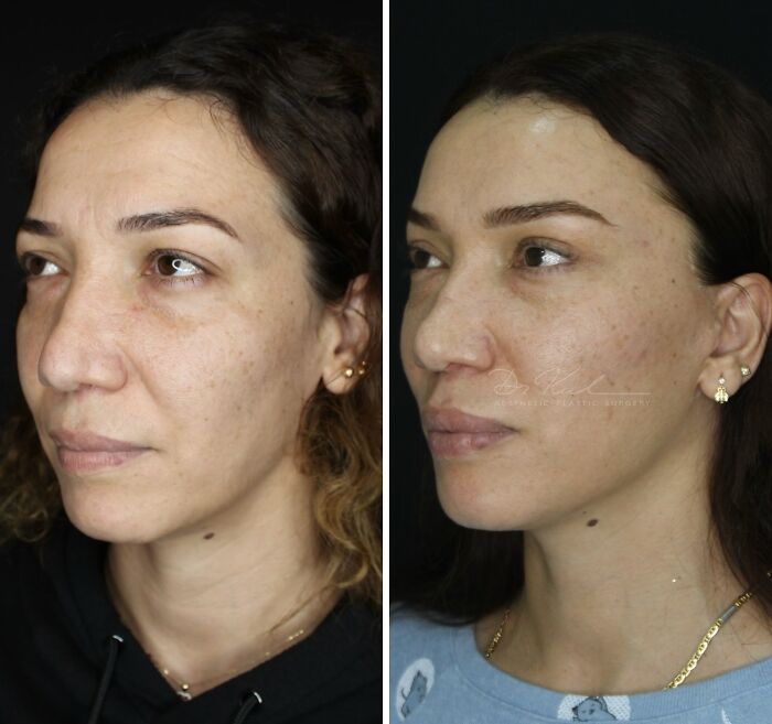 67 People Who Became Completely Unrecognizable After Getting Cosmetic Surgery In Turkey 67 People Who Became Completely Unrecognizable After Getting Cosmetic Surgery In Turkey
