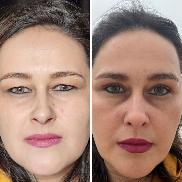 67 People Who Became Completely Unrecognizable After Getting Cosmetic Surgery In Turkey 67 People Who Became Completely Unrecognizable After Getting Cosmetic Surgery In Turkey