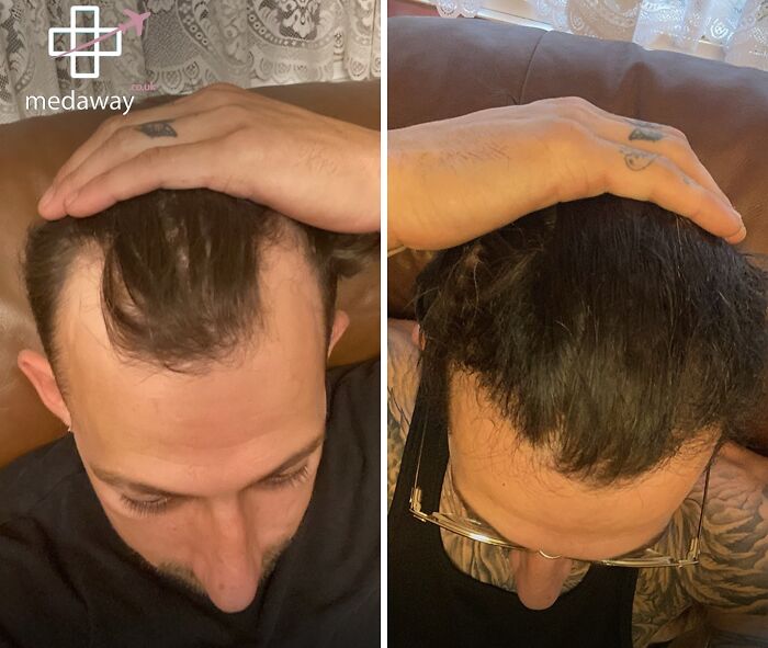 67 People Who Became Completely Unrecognizable After Getting Cosmetic Surgery In Turkey