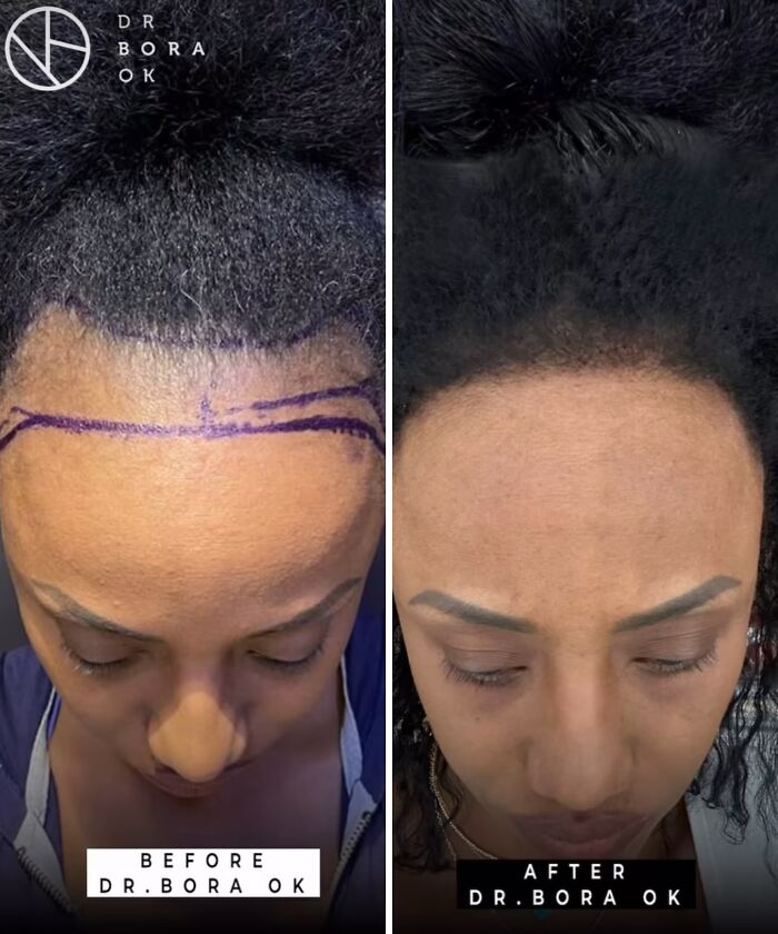 67 People Who Became Completely Unrecognizable After Getting Cosmetic Surgery In Turkey