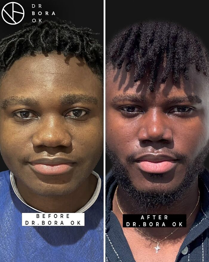 67 People Who Became Completely Unrecognizable After Getting Cosmetic Surgery In Turkey 67 People Who Became Completely Unrecognizable After Getting Cosmetic Surgery In Turkey