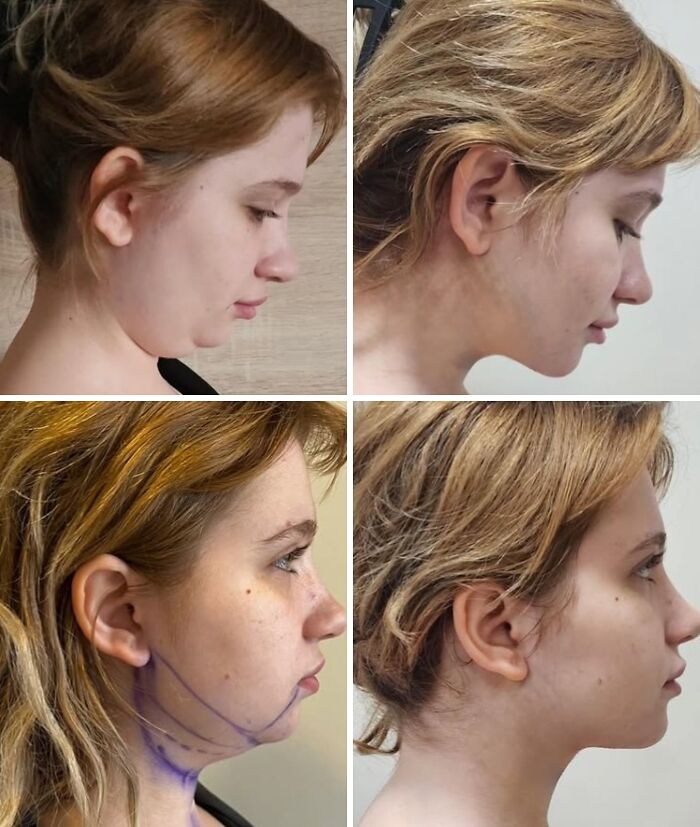 67 People Who Became Completely Unrecognizable After Getting Cosmetic Surgery In Turkey 67 People Who Became Completely Unrecognizable After Getting Cosmetic Surgery In Turkey