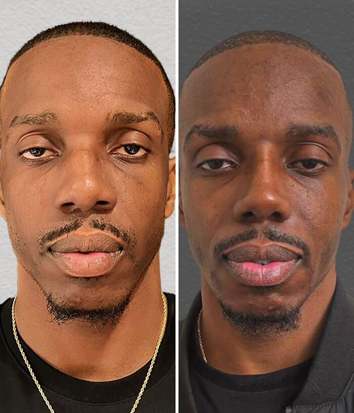 67 People Who Became Completely Unrecognizable After Getting Cosmetic Surgery In Turkey