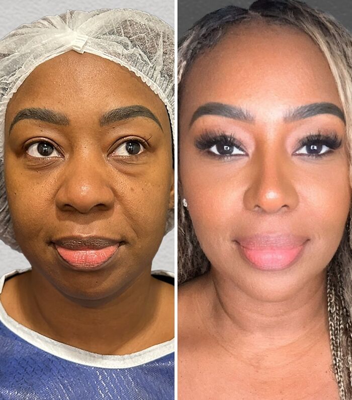 67 People Who Became Completely Unrecognizable After Getting Cosmetic Surgery In Turkey 67 People Who Became Completely Unrecognizable After Getting Cosmetic Surgery In Turkey