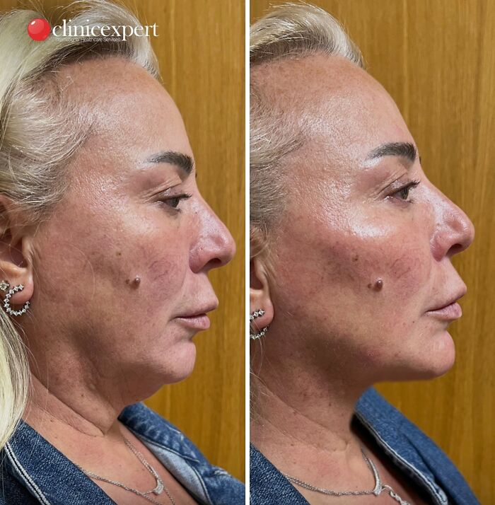 67 People Who Became Completely Unrecognizable After Getting Cosmetic Surgery In Turkey 67 People Who Became Completely Unrecognizable After Getting Cosmetic Surgery In Turkey