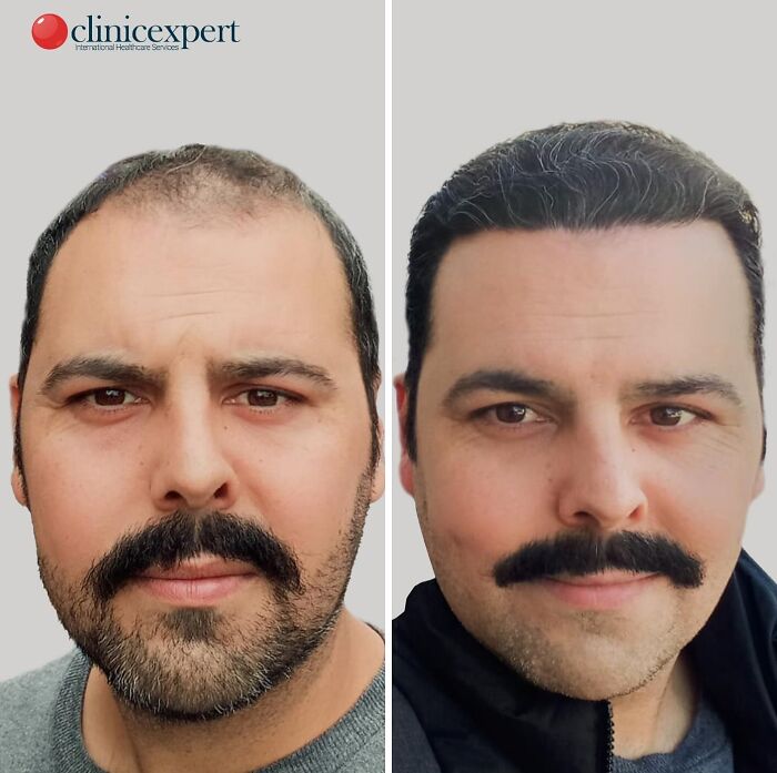 67 People Who Became Completely Unrecognizable After Getting Cosmetic Surgery In Turkey 67 People Who Became Completely Unrecognizable After Getting Cosmetic Surgery In Turkey