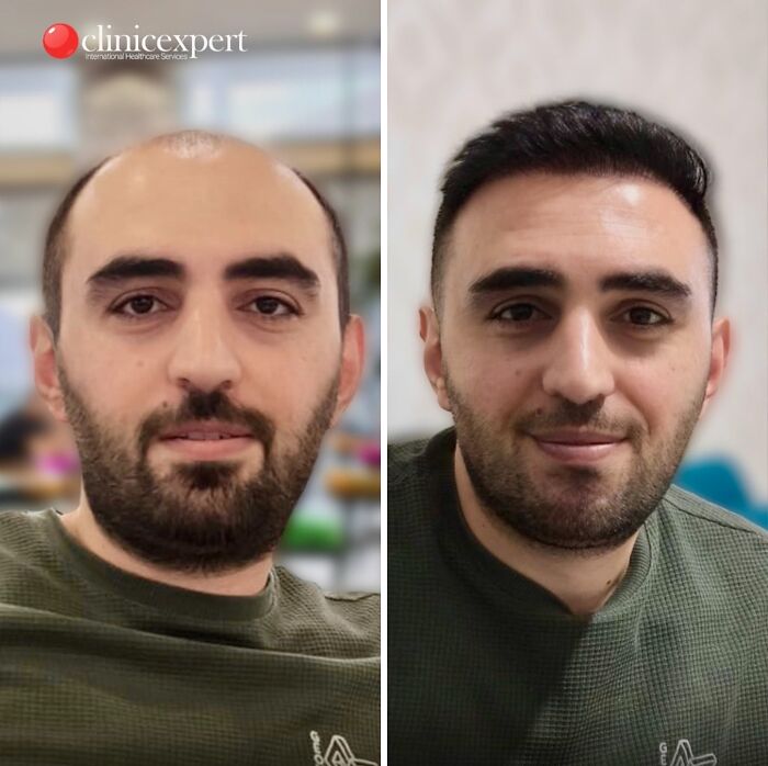 67 People Who Became Completely Unrecognizable After Getting Cosmetic Surgery In Turkey 67 People Who Became Completely Unrecognizable After Getting Cosmetic Surgery In Turkey