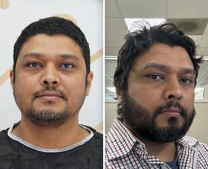 67 People Who Became Completely Unrecognizable After Getting Cosmetic Surgery In Turkey 67 People Who Became Completely Unrecognizable After Getting Cosmetic Surgery In Turkey