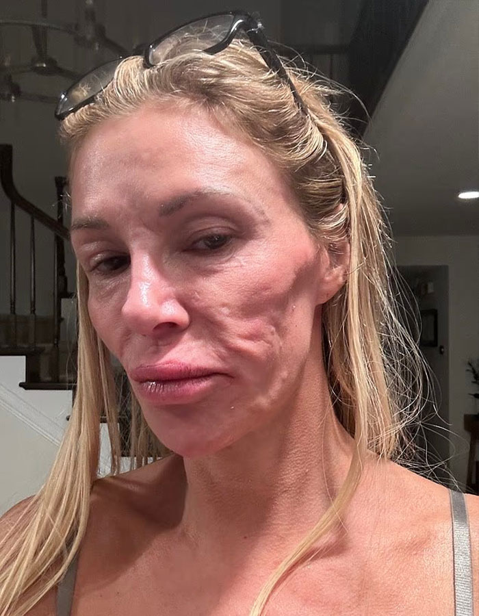 “Psychosis On Display”: Brandi Glanville Goes Bold In Red Bikini After Face Disfigurement Diagnosis “Psychosis On Display”: Brandi Glanville Goes Bold In Red Bikini After Face Disfigurement Diagnosis