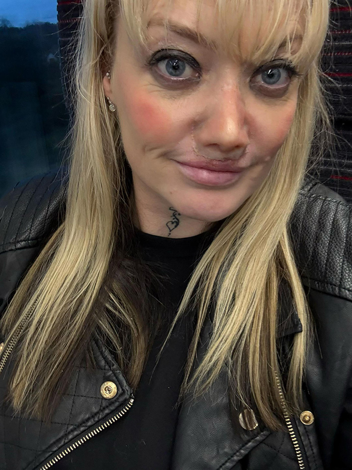 &ldquo;My Face Is Changing Every Day!&rdquo;: Woman’s $4k ‘Turkey Teeth’ Procedure Goes Horribly Wrong