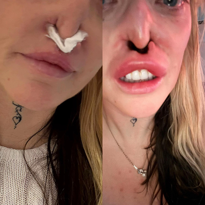 &ldquo;My Face Is Changing Every Day!&rdquo;: Woman’s $4k ‘Turkey Teeth’ Procedure Goes Horribly Wrong