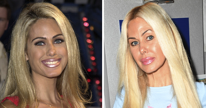 20 Celebrities Who Learned The Hard Way About Plastic Surgery