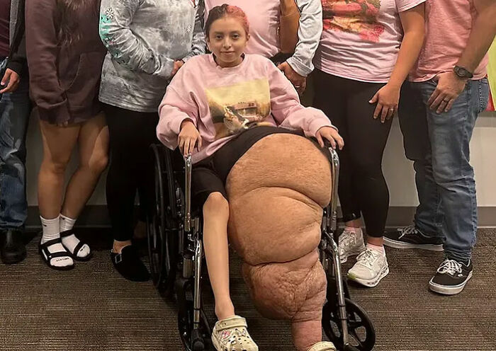 14YO Girl With Rare Condition Undergoes 17 Hours Of Grueling Surgery To Remove 174lb Leg