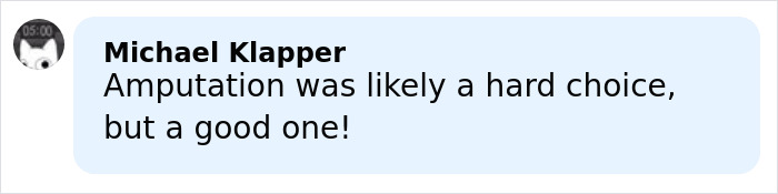 14YO Girl With Rare Condition Undergoes 17 Hours Of Grueling Surgery To Remove 174lb Leg