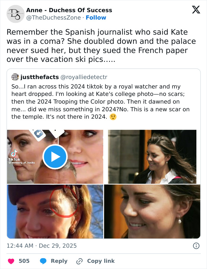 Kate Middleton’s Facial Scar Fuels Rumors Her 2024 Hospitalization Was More Serious Than Claimed Kate Middleton’s Facial Scar Fuels Rumors Her 2024 Hospitalization Was More Serious Than Claimed