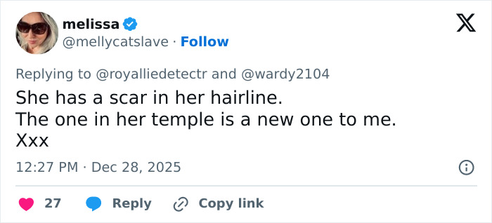 Kate Middleton’s Facial Scar Fuels Rumors Her 2024 Hospitalization Was More Serious Than Claimed Kate Middleton’s Facial Scar Fuels Rumors Her 2024 Hospitalization Was More Serious Than Claimed