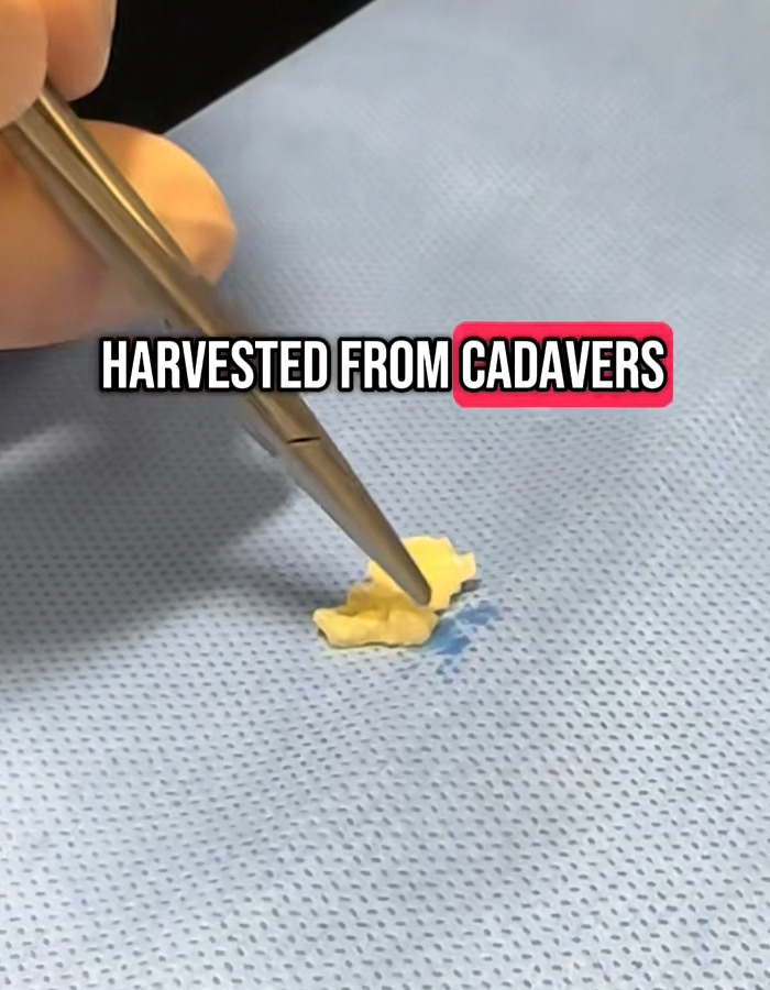 Why Donated Lifeless Bodies Are Being Used For BBLs And Breast Implants Now Why Donated Lifeless Bodies Are Being Used For BBLs And Breast Implants Now