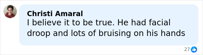 “That’s Why His Face Is Droopy”: Trump Tries To Shut Down Health Speculation As Doctor Raises Concerns