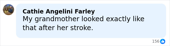 “That’s Why His Face Is Droopy”: Trump Tries To Shut Down Health Speculation As Doctor Raises Concerns