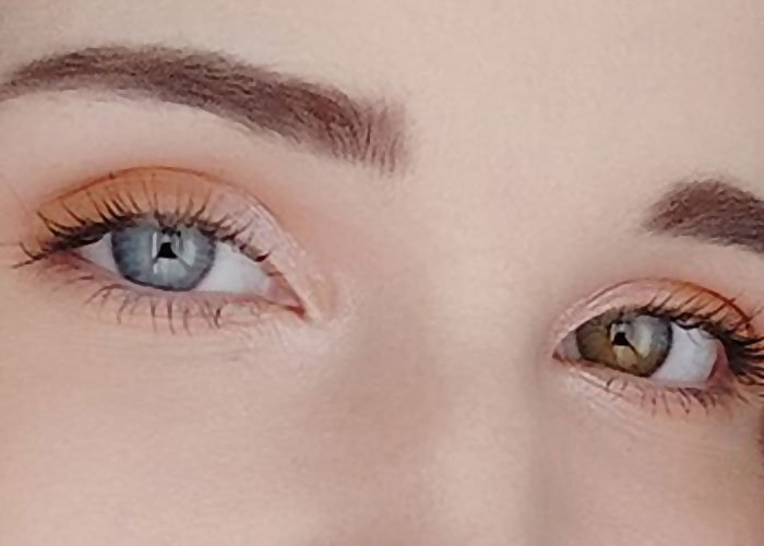 “He was Severely Bullied”: 83 Rare Physiological Traits That Most People Will Never See In Person