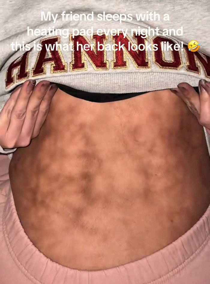 Woman’s Video Goes Viral After She Shows How Her Body Looks After Using A Heating Pad: “Toasted Skin Syndrome”